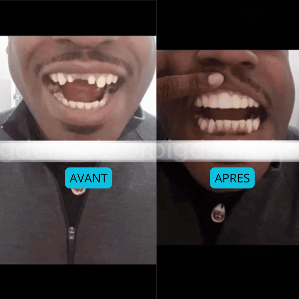 TeethRepair™ : Kit De Réparation De Dents A L’Apparence Naturelle – Image 2