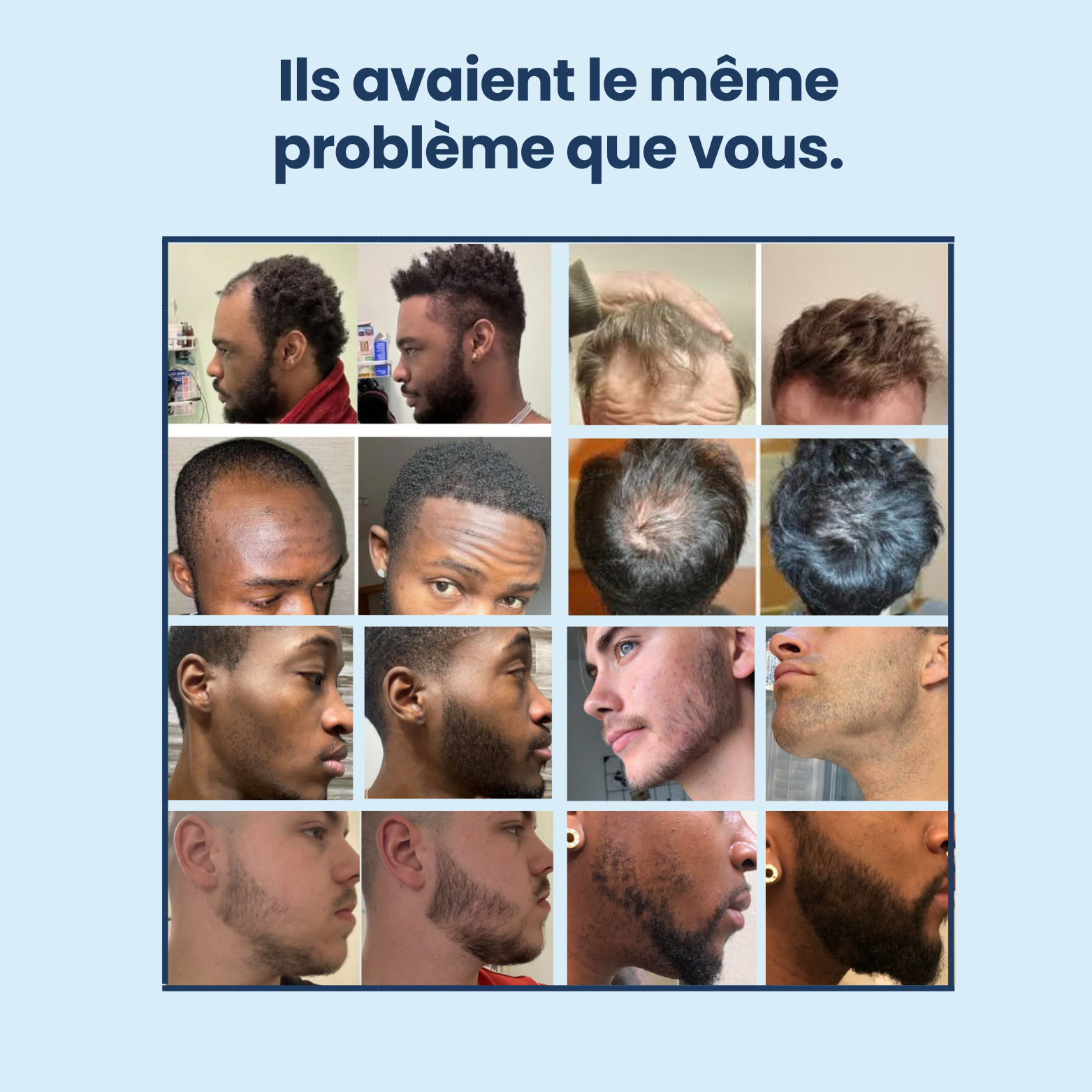 Application roller cuir chevelu