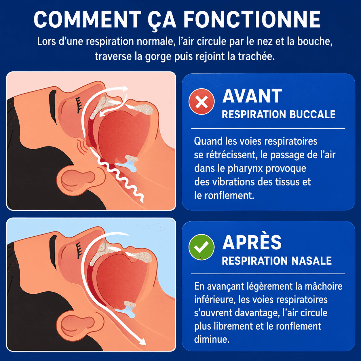 Illustration du fonctionnement de l’Orthèse anti ronflement